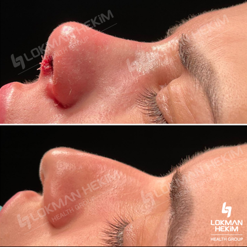Septoplasty Before / After photo